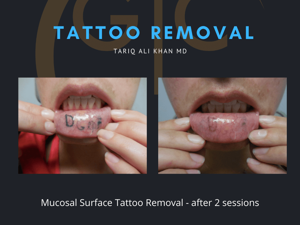 Gentle Care Laser Tustin & Long Beach Before and After picture - Tattoo Removal Mucosal Surface